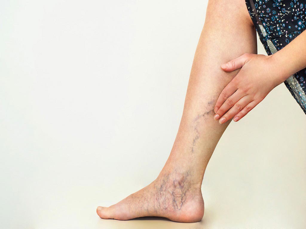 A woman showing the varicose veins in her foot and leg